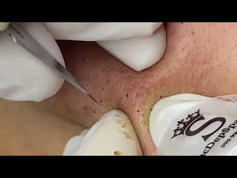 Epic BLACKHEAD REMOVAL – Best I Have Seen