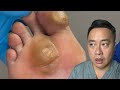 MONSTER FOOT CALLUS REMOVAL