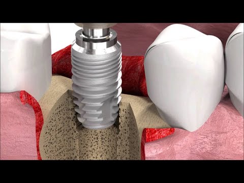 , title : 'Video implant dentar - Etape procedura de inserare implant dentar'