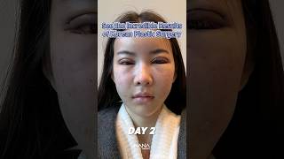 Download lagu Korean plastic surgery's stunning results #koreanplasticsurgery mp3 Download lagu Korean plastic surgery's stunning results #koreanplasticsurgery mp3