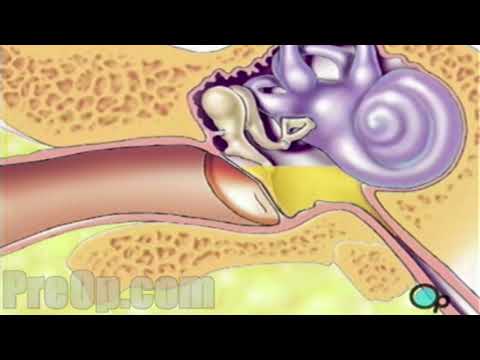 Myringotomie Einsetzen einer Tube-Chirurgie PreOp® Patientenaufklärung