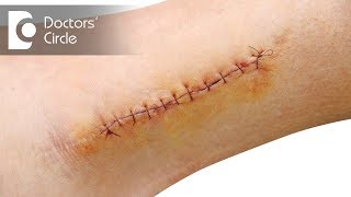 How to get rid of scars due to stitches? - Dr. Sachith Abraham