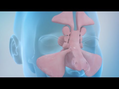 Sinusitis and Sinus Surgery Explained (Balloon Sinuplasty and Endoscopic Sinus Surgery)