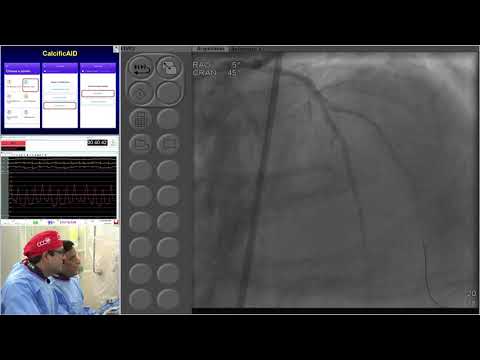 LC #5 - Heavily Calcified Both LAD/D1 Bifurcation PCI using Atherectomy - CCC 2019