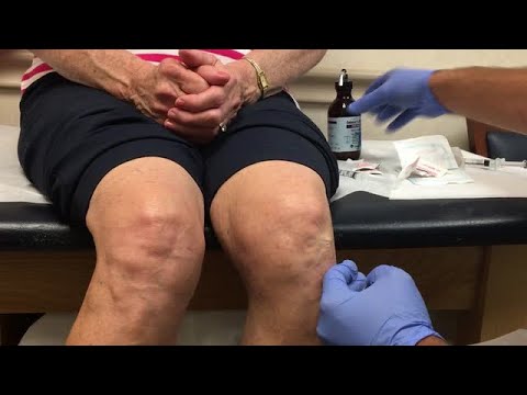 Intra-Articular Viscosupplementation Injection in the Knee