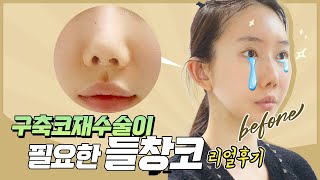 구축코 재수술이 필요한 들창코 솔직후기 1탄