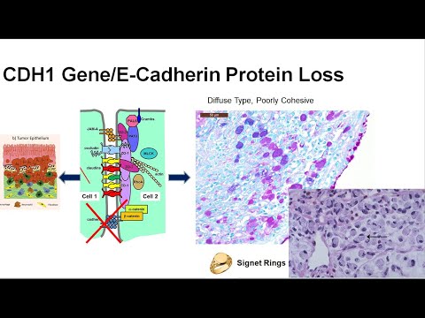 6  What is the Genetic Basis of GEC? Inherited vs Acquired CDH1 mutation/loss