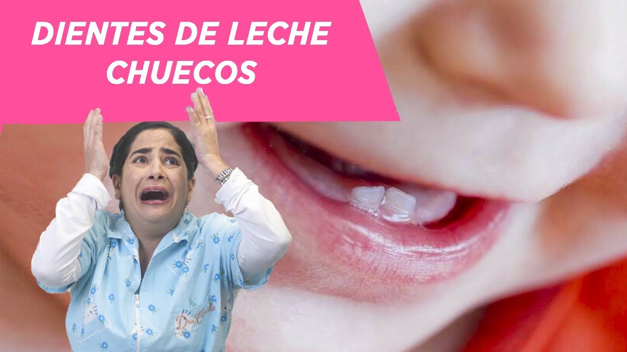 Dientes de leche chuecos