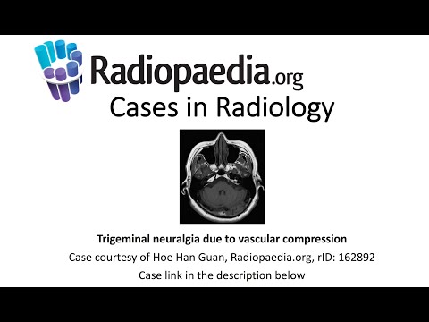 Trigeminal neuralgia due to vascular compression (Radiopaedia.org) Cases in Radiology