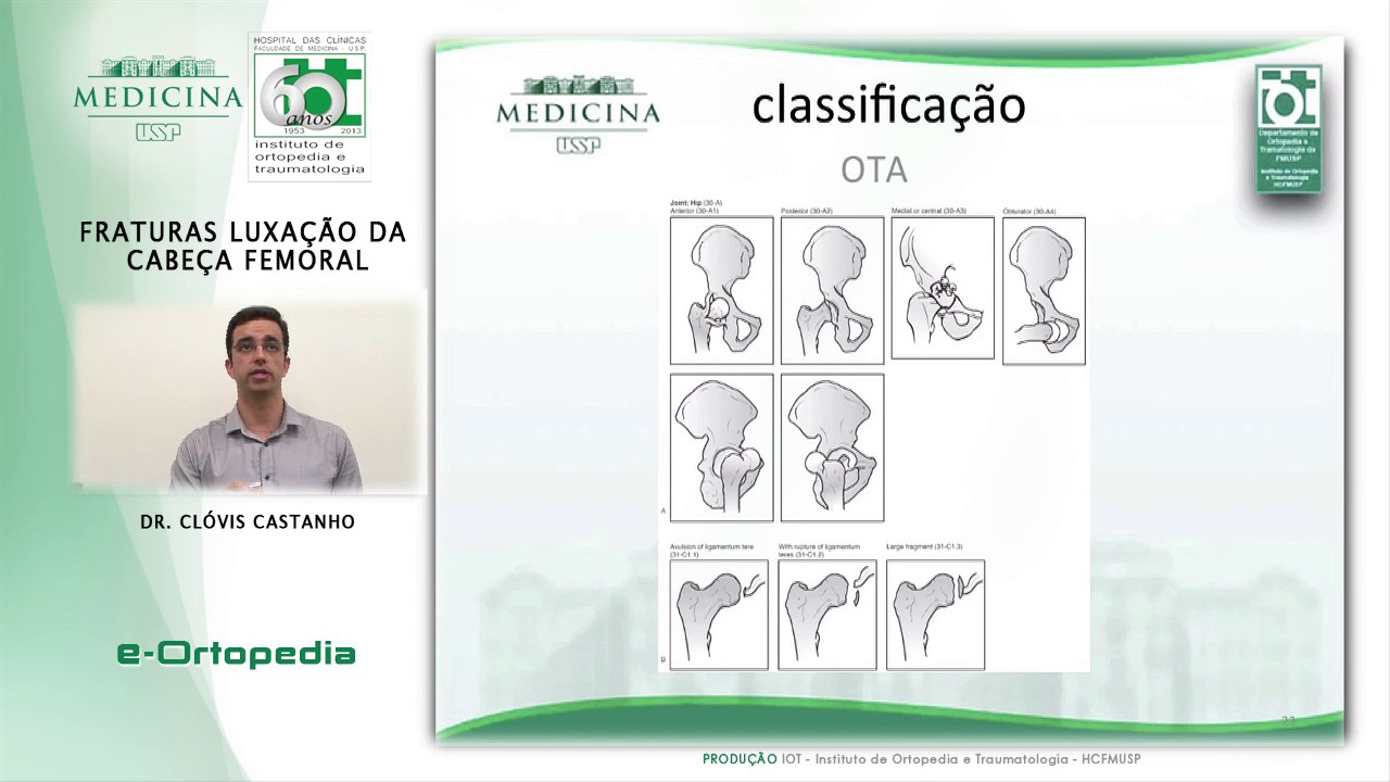 Fratura Luxação da Cabeça Femoral - Dr. Clóvis Castanho