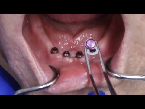 Zest LOCATOR R-Tx Technique - Placing Abutments & Pick-up of Housing in Denture
