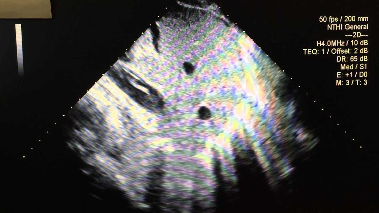 Echo Case 4 (Part 1)