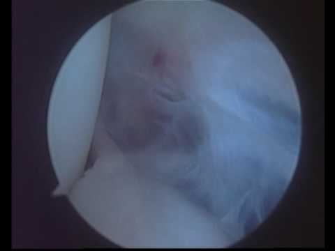Tear Of The Capsule In Multiple Shoulder Displacement