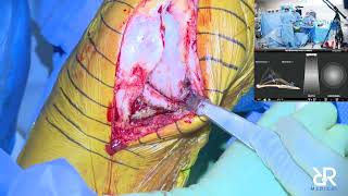 Dr. Stefan Kreuzer performs Right Total Knee Arthroplasty using OMNIBotics