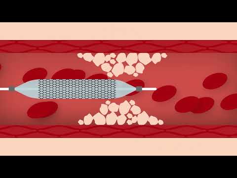 Heart Stent Procedure