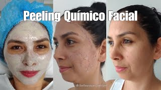Peeling Químico Facial | Renueva tu Piel