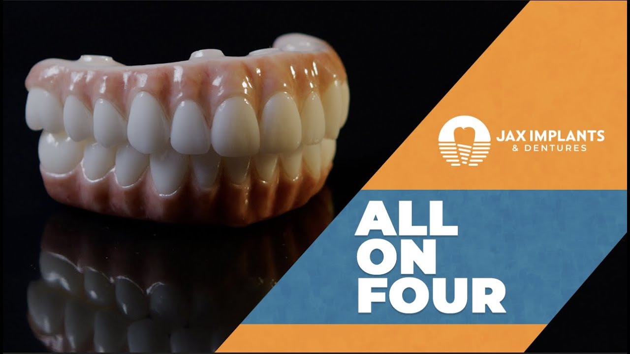 All On 4 Dental Implants. What You Should Know and Cost