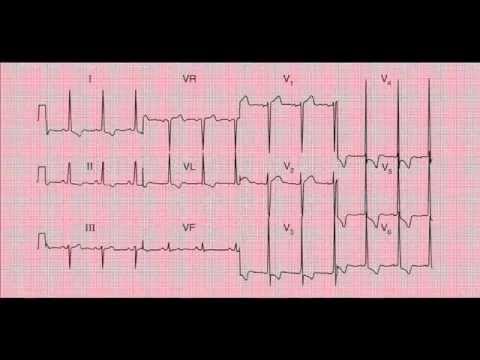 Examples to master 12 lead ECG / EKG interpretation - workshop 3