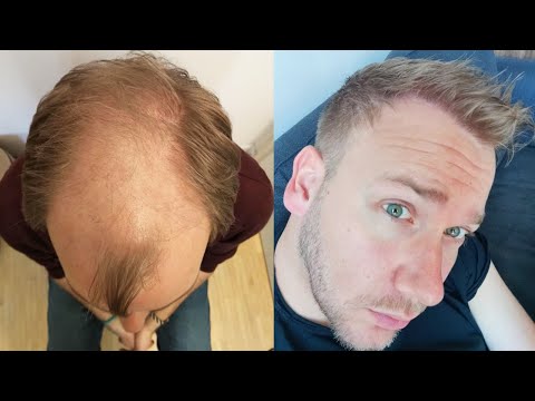 Hair Transplant Before and After - Month by Month...