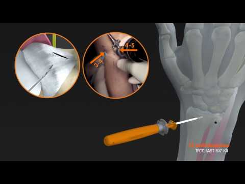 Segni di osteocondrosi della zona del collo Gonfiore delle articolazioni