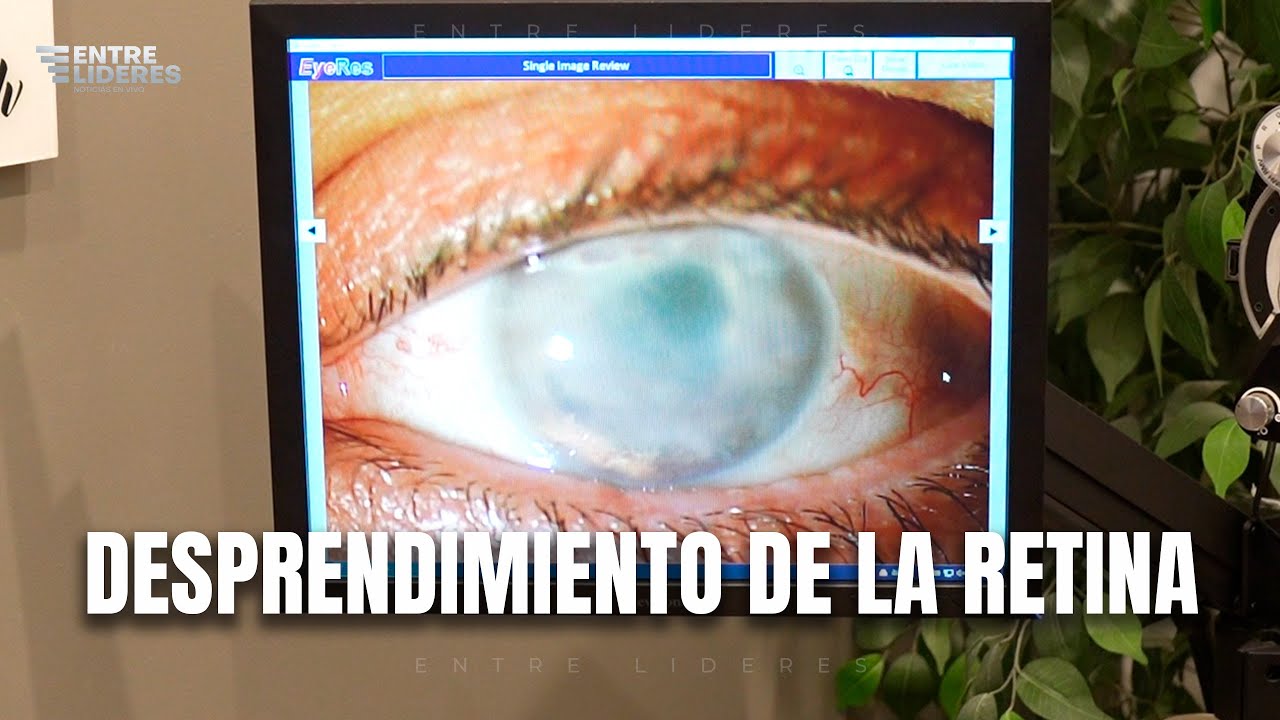 Desprendimiento de la retina | Compton Eye Associates