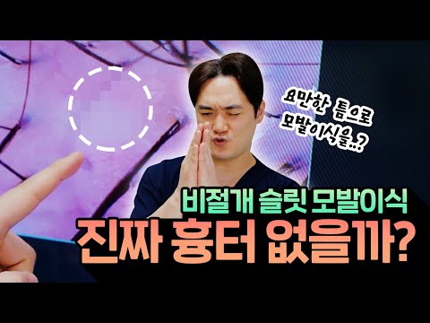 슬릿(Slit) 방식의 비절개 모발이식에 대해서 모두 알려드립니다!