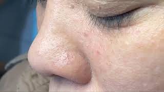 Remove blackheads simply with tweezers 3