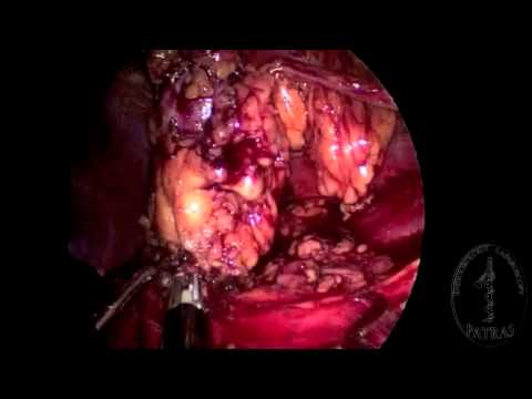 Transvaginal Nephrectomy - Hilar Dissection
