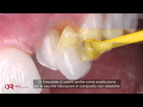 Faccette dentali Croazia | Ljuskice za zube - Veneers | Cijena | Štimac Centar dentalne medicine | Ljuskice za zube | Stomatološka poliklinika Zagreb | Štimac centar dentalne medicine