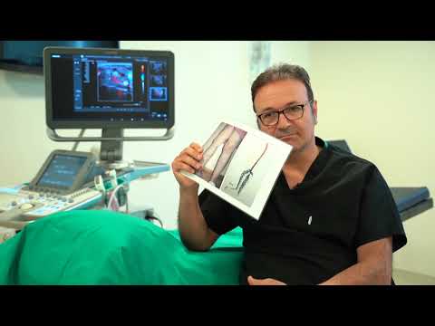 HOW WE TREAT VARICOSE VEINS NONSURGICALLY: VARISSON VEIN CENTER