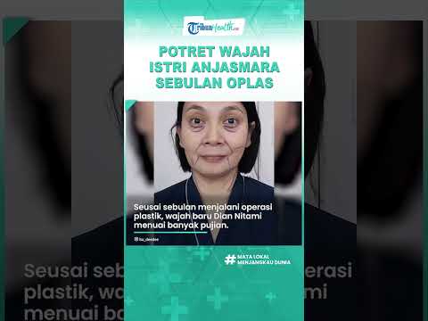 Disebut Hasilnya Natural, Intip Potret Dian Nitami seusai Sebulan Operasi Plastik, Tampak Awet Muda
