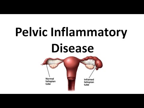 Pelvic Inflammatory Disease (PID)