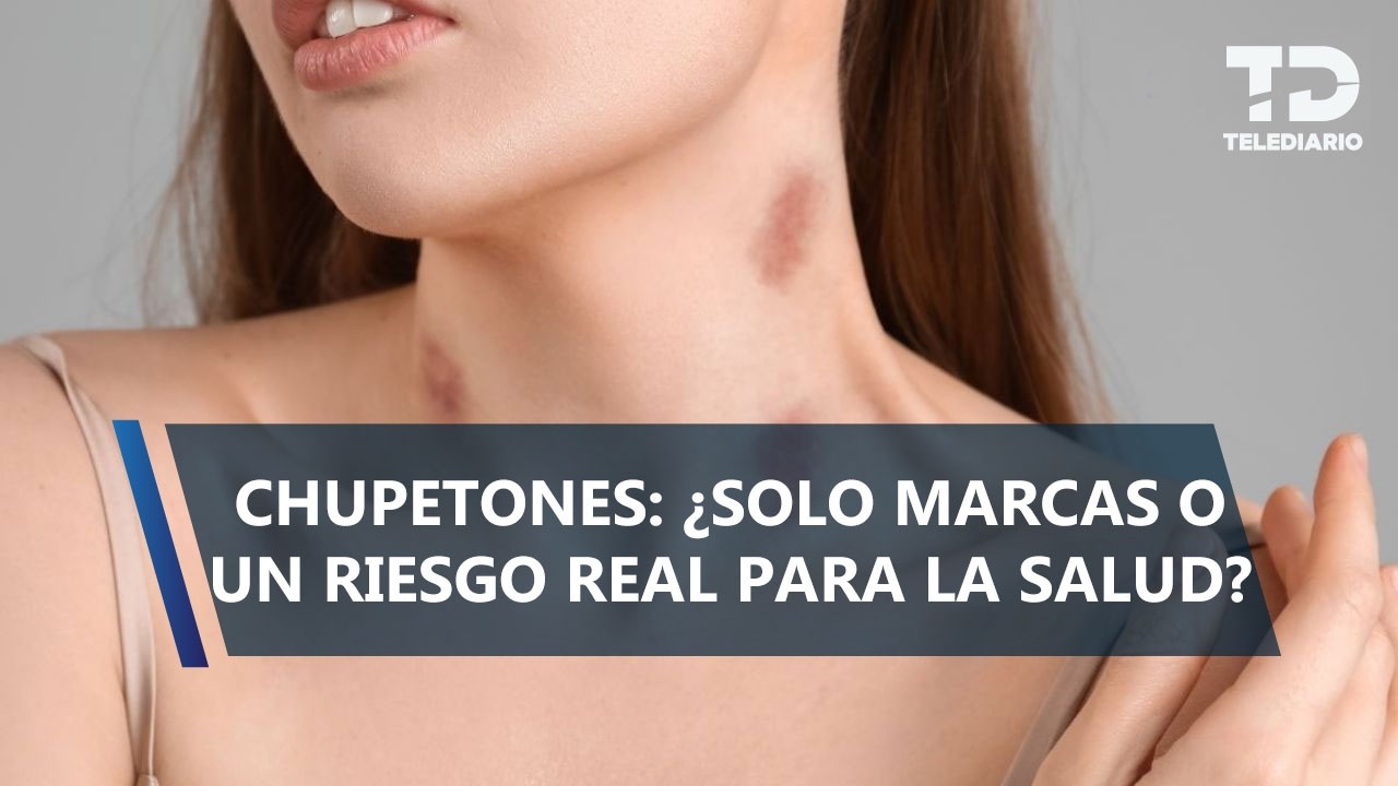 ¿Los “chupetones” son peligrosos? Esto dicen los expertos sobre su impacto en la salud