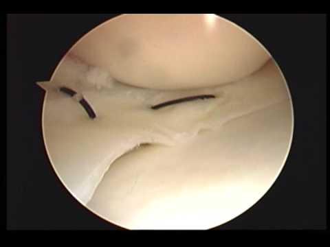 Vertical And Horizontal Stitch In Meniscus Correction