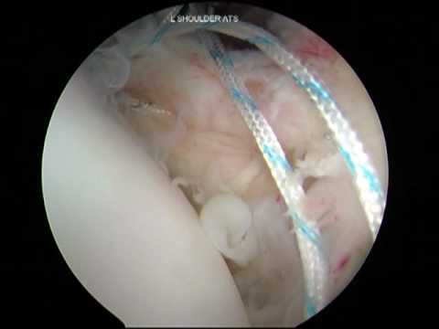 Cascio Shoulder Instability  Arthroscopy: HAGL Lesion Part 3 of 3