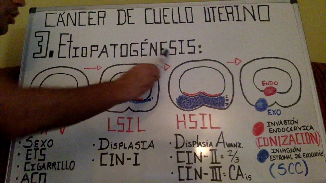 Cáncer de Cuello Uterino