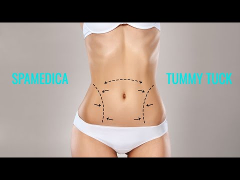 Mini Tummy Tuck Toronto - Partial Abdominoplasty