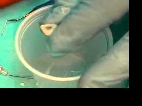 Video 06 Cleaning and shaping in a plastic tooth - using the Gates-glidden drill Part 2