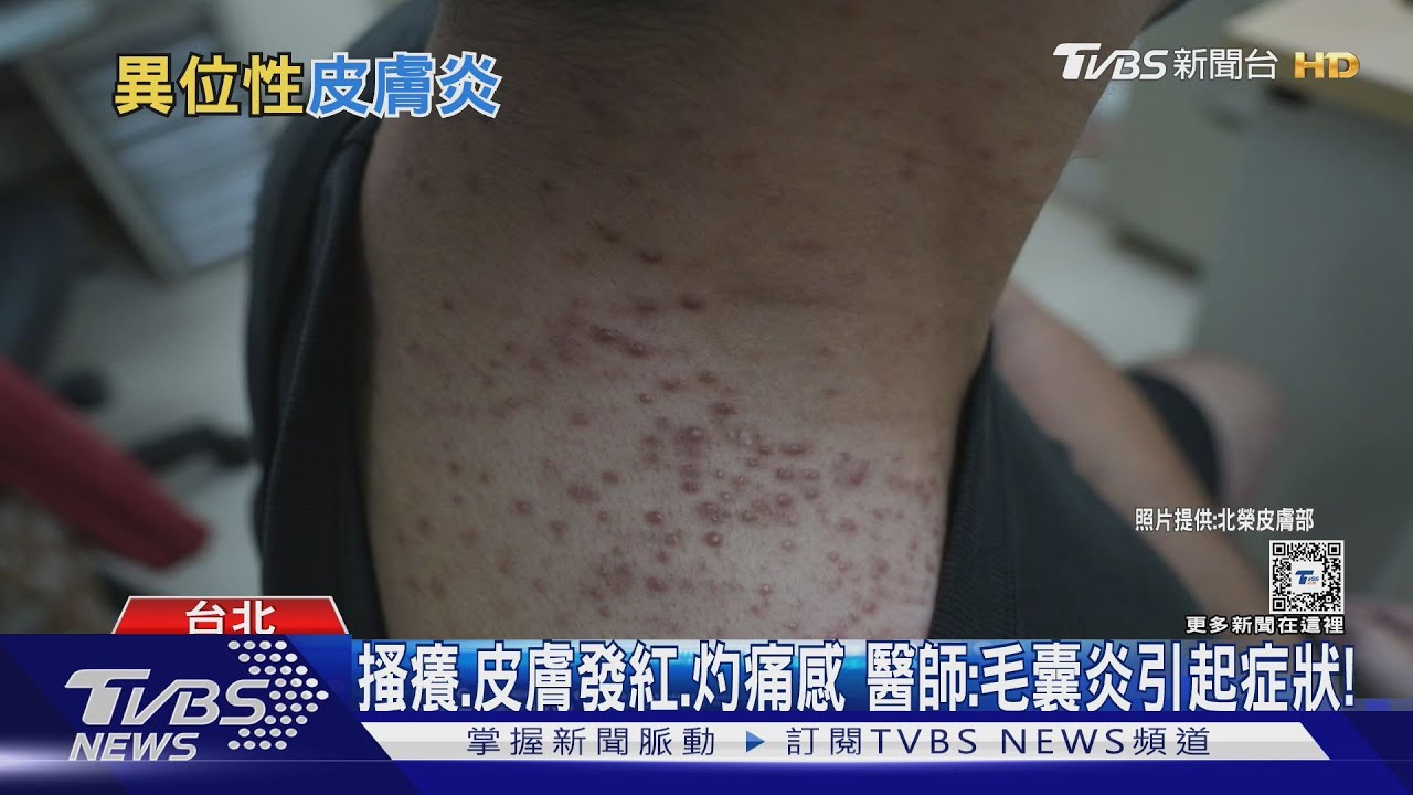 潮濕、悶熱環境易生長「這種菌」!醫師警告:輕忽它全身恐出現不舒適感