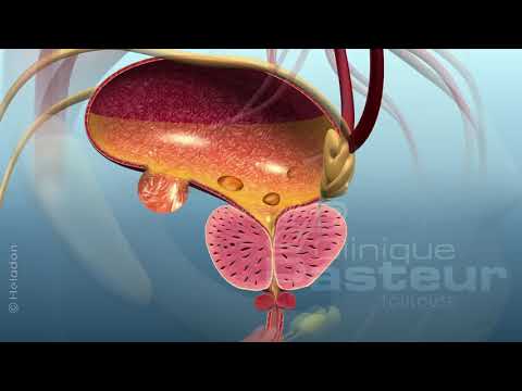 Prostata-Kerzen Analyse von Prostata-Sekret, wie viel Zeit
