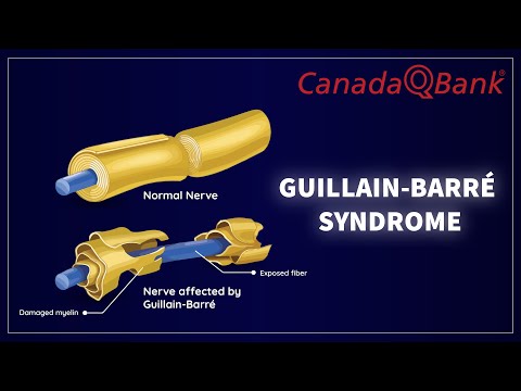 Guillain-Barré Syndrome (GBS): Causes, Symptoms, Diagnosis & Treatment | Neurology Review