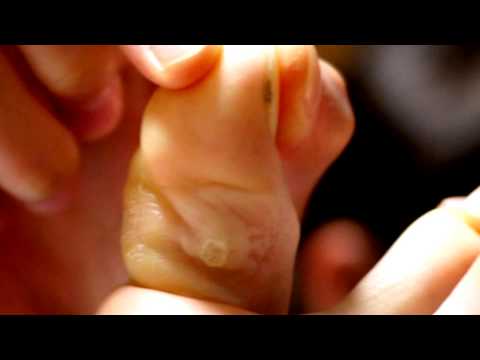 comment traiter verrue plantaire