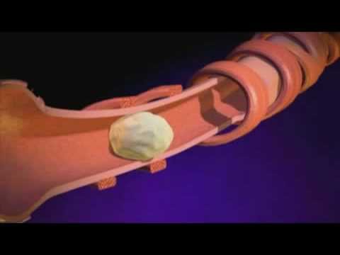 comment soigner pneumothorax
