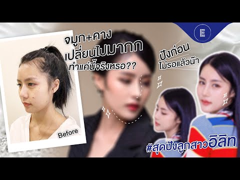 แก้จมูก และเสริมคางกับคุณหมอโต๋ที่ Elite Clinic คลินิกศัลยกรรมเชียงราย หน้าสวยได้รูป ปังมาก !