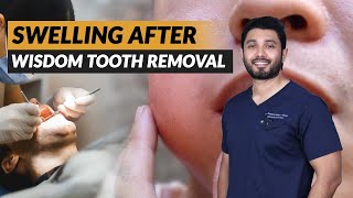 Swelling After Wisdom Teeth Removal ! | Dr. Jibran