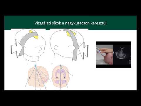 magas vérnyomás a szív ultrahangján