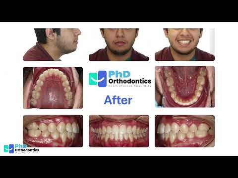 Class I crowding, anterior crossbite