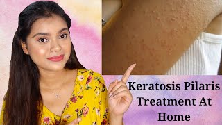 Chicken Skin Treatment | Keratosis Pilaris Treatment at Home | How to Treat Rough and Bumpy Skin