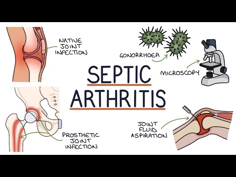 Understanding Septic Arthritis