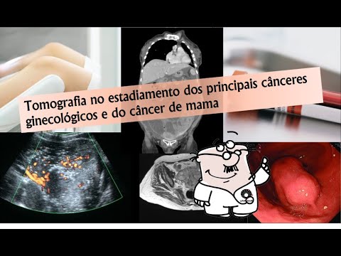 Tomografia no estadiamento dos principais cânceres ginecológicos e do câncer de mama